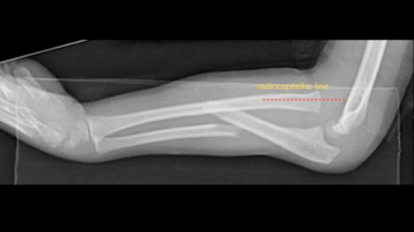 <p>Ulnar fracture --> dislocation of radio-humeral joint</p>