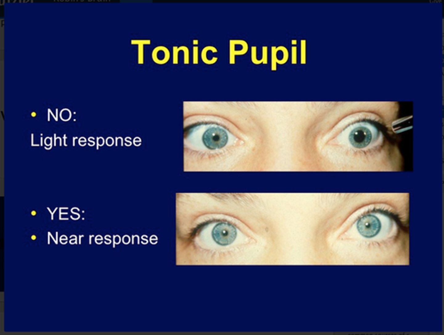 <p>Poor response to light</p><p>Stronger response to near target</p><p>Accommodative paresis</p><p>Cholinergic supersensitivity</p>