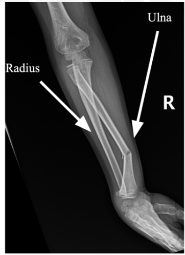 <p><span>when a bone breaks and the broken ends are no longer aligned properly</span></p>