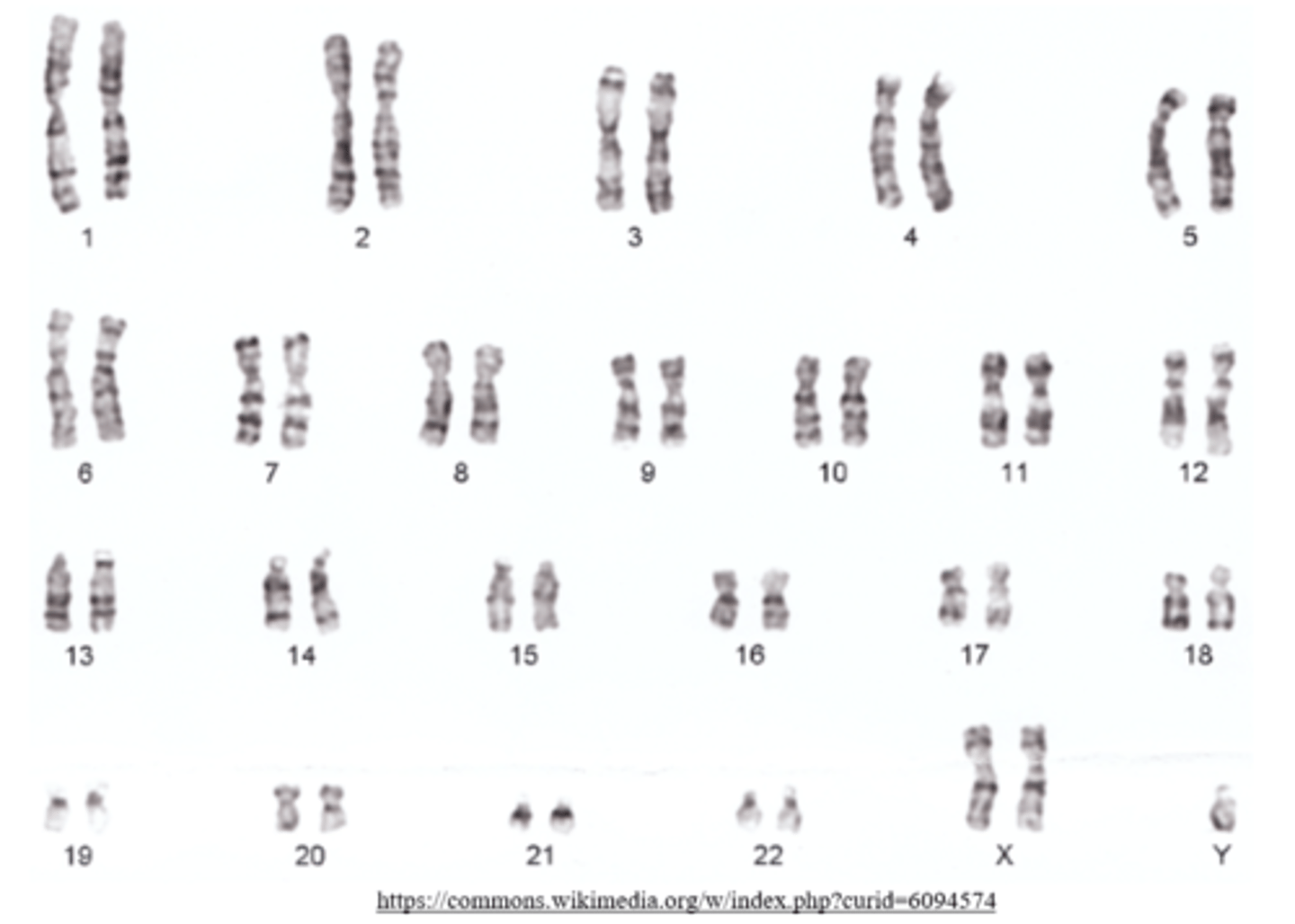 <p>Klinefelter syndrome</p>