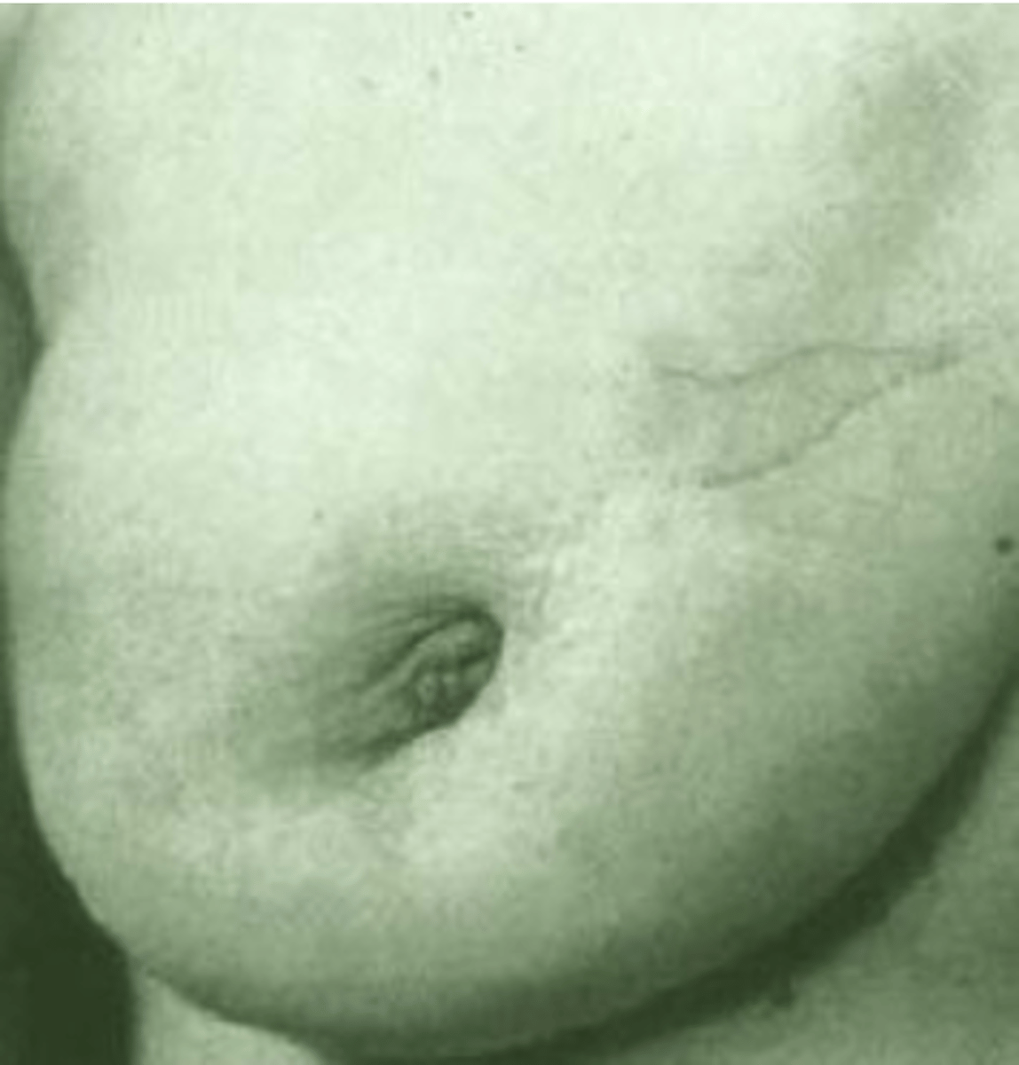<p>a. Dimpling</p><p>-Nipple retraction</p><p>b. Edema (peau d'orange)</p><p>c. Fixation</p><p>d. Deviation in nipple pointing</p>