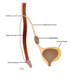 <p>what type of anomalies of urachus is this</p>