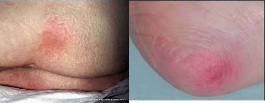 <p><strong>What stage pressure injury?</strong></p><ul><li><p><strong>intact</strong> skin with localized area of non blanchable erythema</p><ul><li><p><em>does NOT include purple or maroon discoloration</em></p></li></ul></li><li><p>± edema, induration, warmth</p></li><li><p><u>heal</u>: tissue regeneration </p></li></ul><p></p>