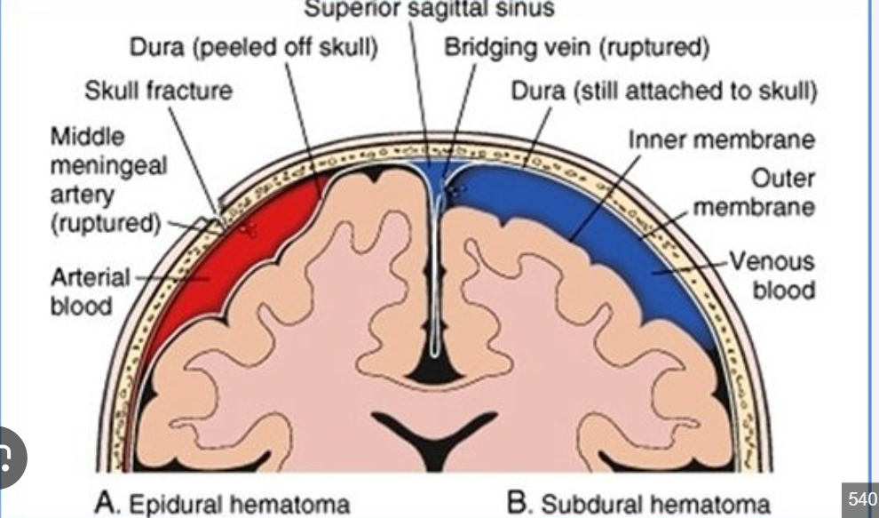 <p><span>a collection of blood that forms between the skull and the dura mater </span></p><p><span>dura mater is injured&nbsp;</span></p><p><span>middle meningeal artery ruptured&nbsp;</span></p><p><span>filled with arterial blood</span></p>