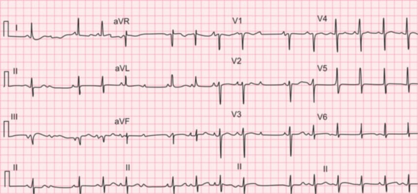 <p>what rhythm is shown in the ECG?</p>