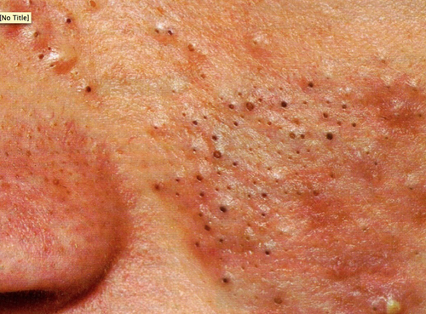 <p>the plugged opening of a sebaceous gland at pore/follicle</p><p>Ex: Acne (white- closed black- open)</p>