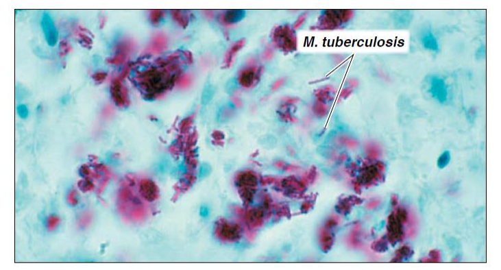 <ol><li><p>red dye carbolfuchsin is applied to a fixed smear and the slide is gently heated for several minutes&nbsp;</p></li><li><p>slide is cooled and washed with water</p></li><li><p>the smear is treated with acid-alcohol (decolorizer) which removed the red stain from bacteria that are not acid-fast&nbsp;</p></li><li><p>smear is then stained with methylene blue (counter stain)&nbsp;</p></li></ol><p></p>