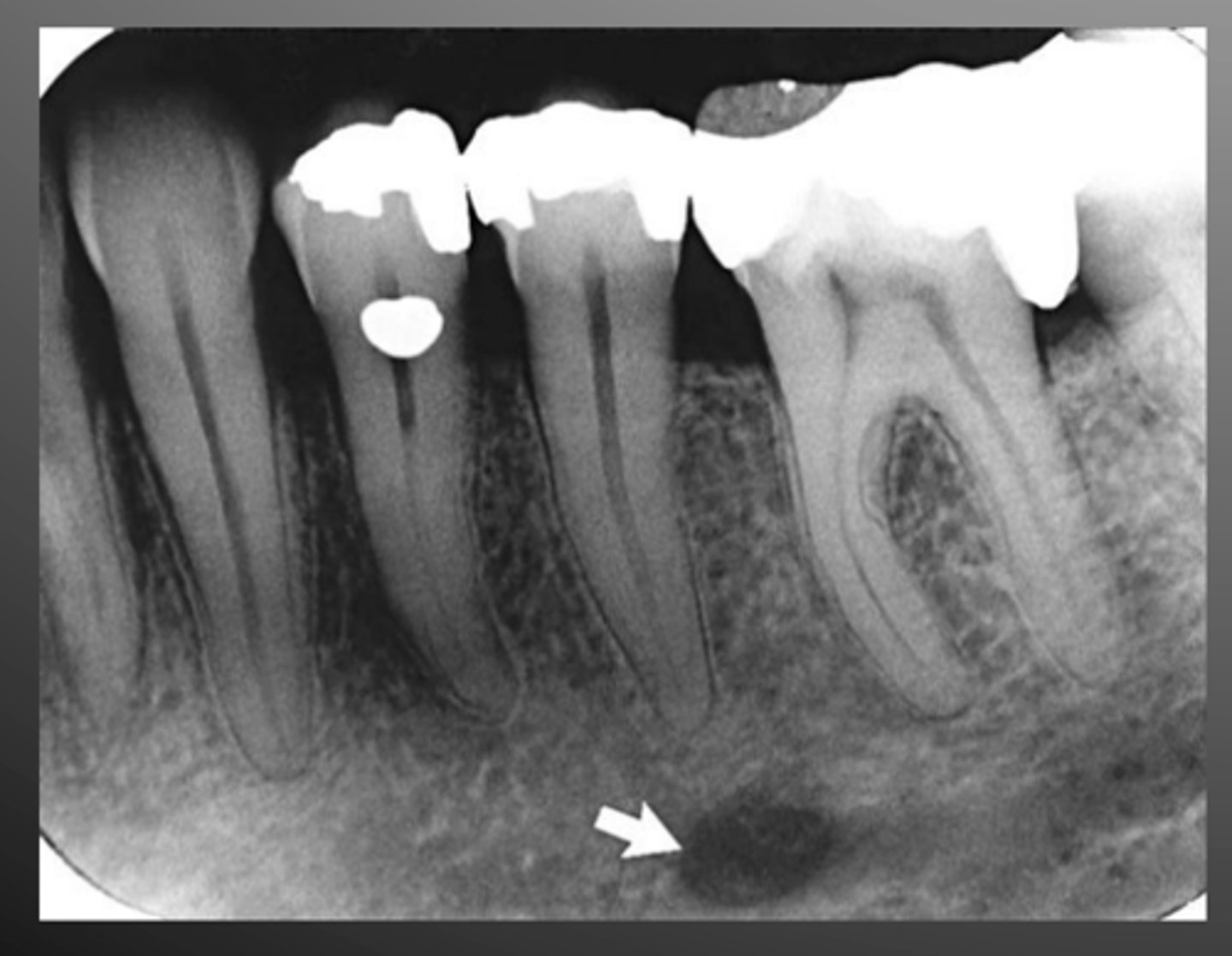<p>hole between roots of premolars</p>