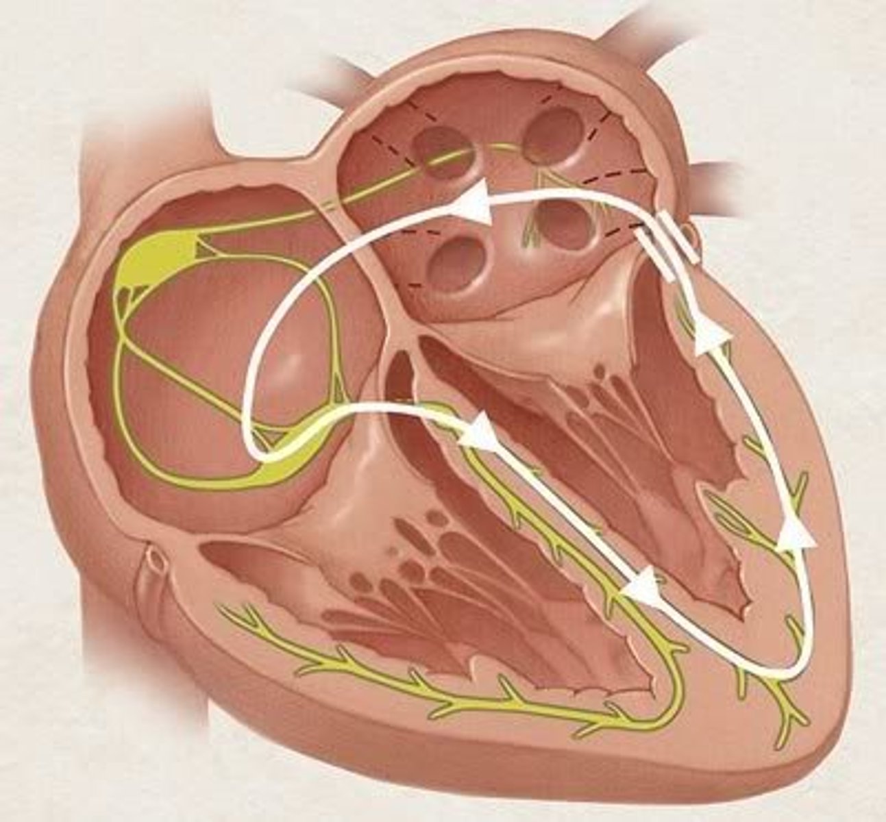 <p>Type of SVT where electrical signals travel through the AV node to the ventricles and then back up to the atria via an accessory pathway, creating a re-entry circuit that causes a rapid heart rate (essentially, the electrical signal travels in the "correct" direction through the AV node and then back up through an abnormal pathway, causing tachycardia)</p>