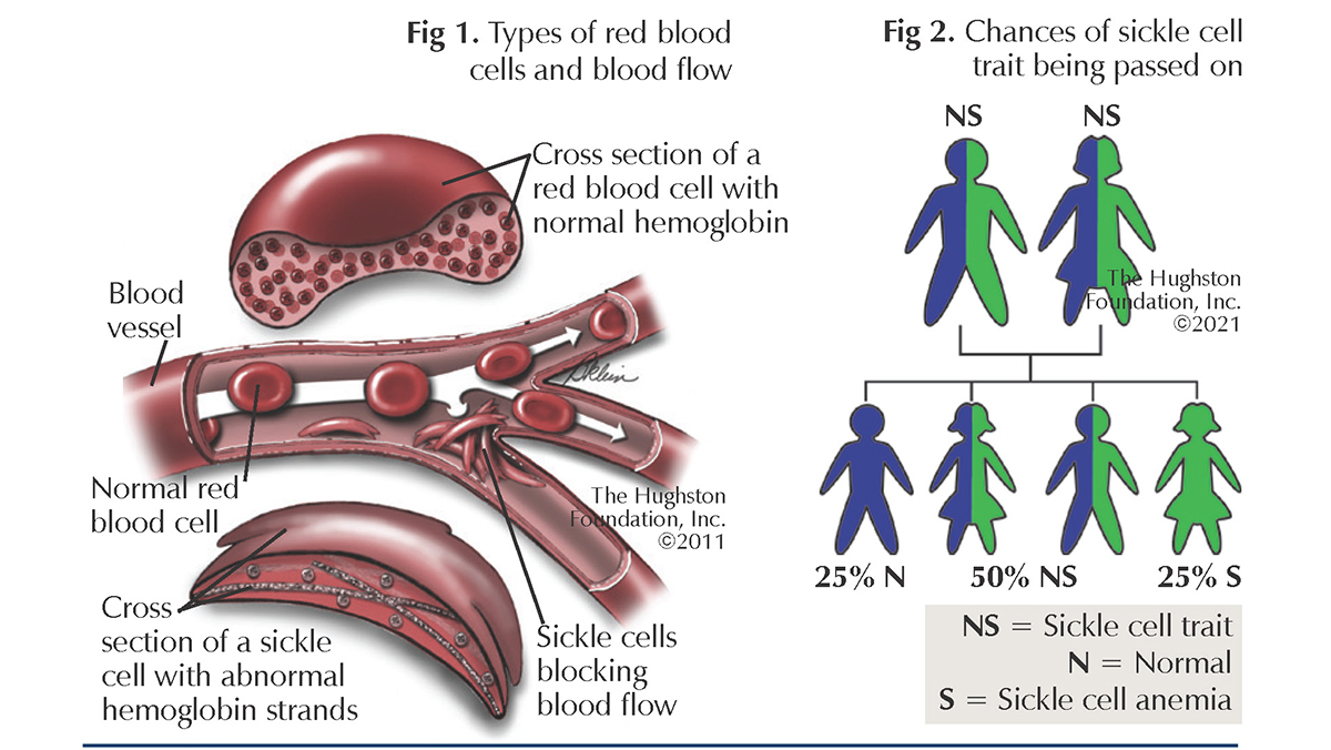 <ul><li><p><strong>Sickle cell disease:</strong> Two abnormal β genes → ~<strong>90% HbS</strong></p></li><li><p><strong>Sickle cell trait:</strong> One abnormal β gene → ~<strong>45% HbS</strong>, remaining is normal HbA</p></li></ul><p></p>