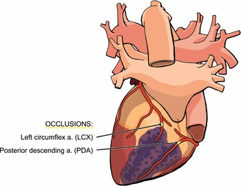 <p><strong>Posterior wall infarction</strong></p><ul><li><p>These leads are used to detect a posterior wall infarction, typically involving the <strong>posterior descending artery.</strong></p></li></ul>