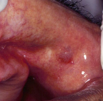 <p>How would you manage a salivary duct cyst?</p>