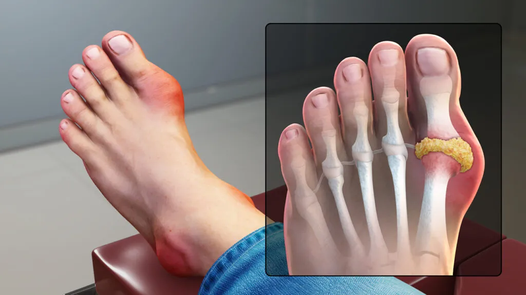 metabolic disease caused by the accumulation of uric acid crystals in the blood that erode bone and produce inflation
