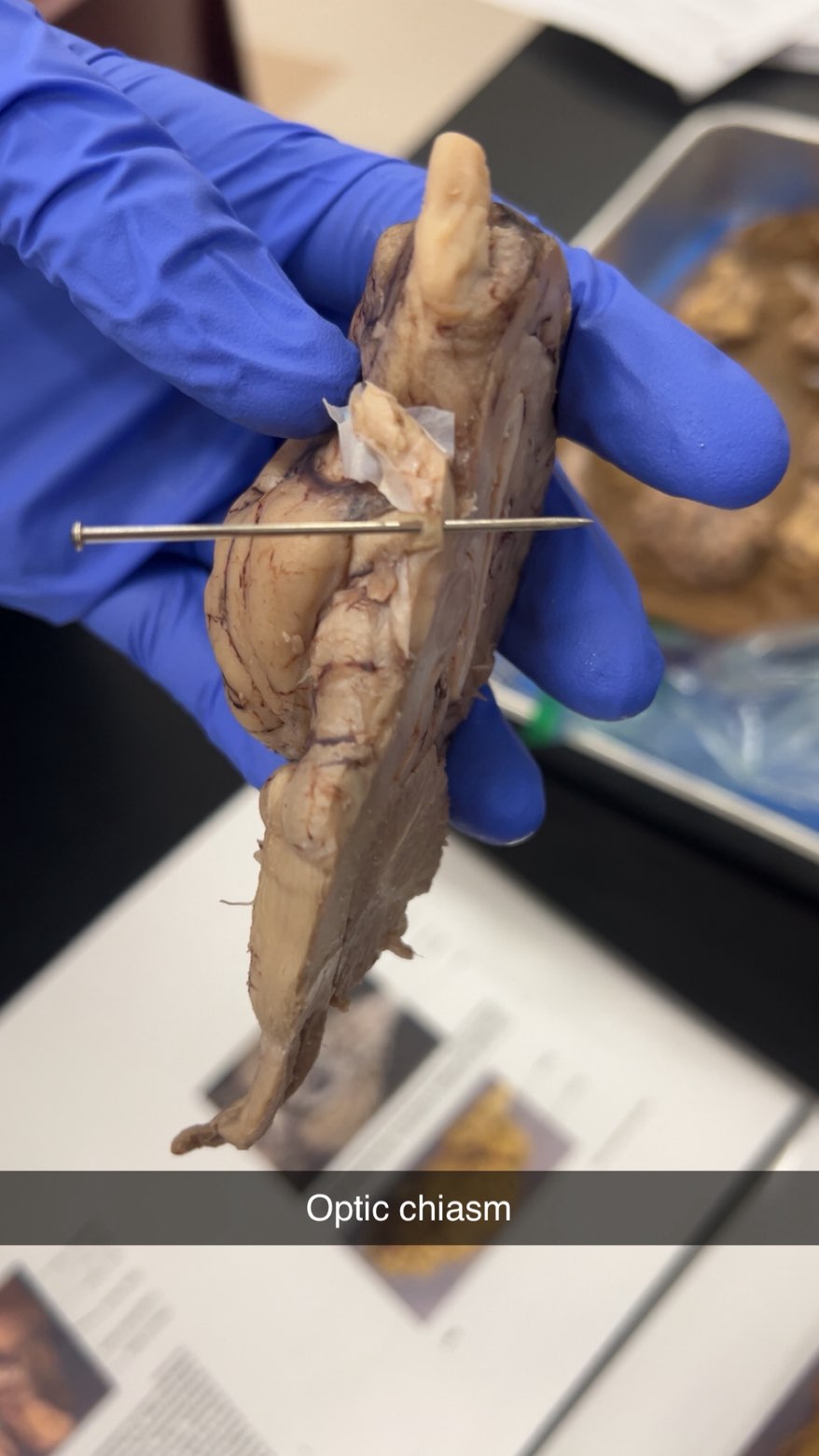 <p>optic chiasm</p>