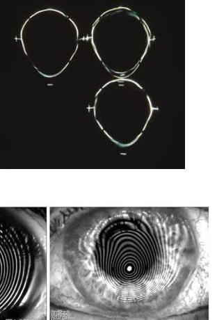 <ul><li><p>distorted mires</p></li><li><p>oblique axis of corneal astigmatism </p></li><li><p>steep curvature </p></li><li><p>difficulty to diagnose early KCN with keratometry </p></li></ul>