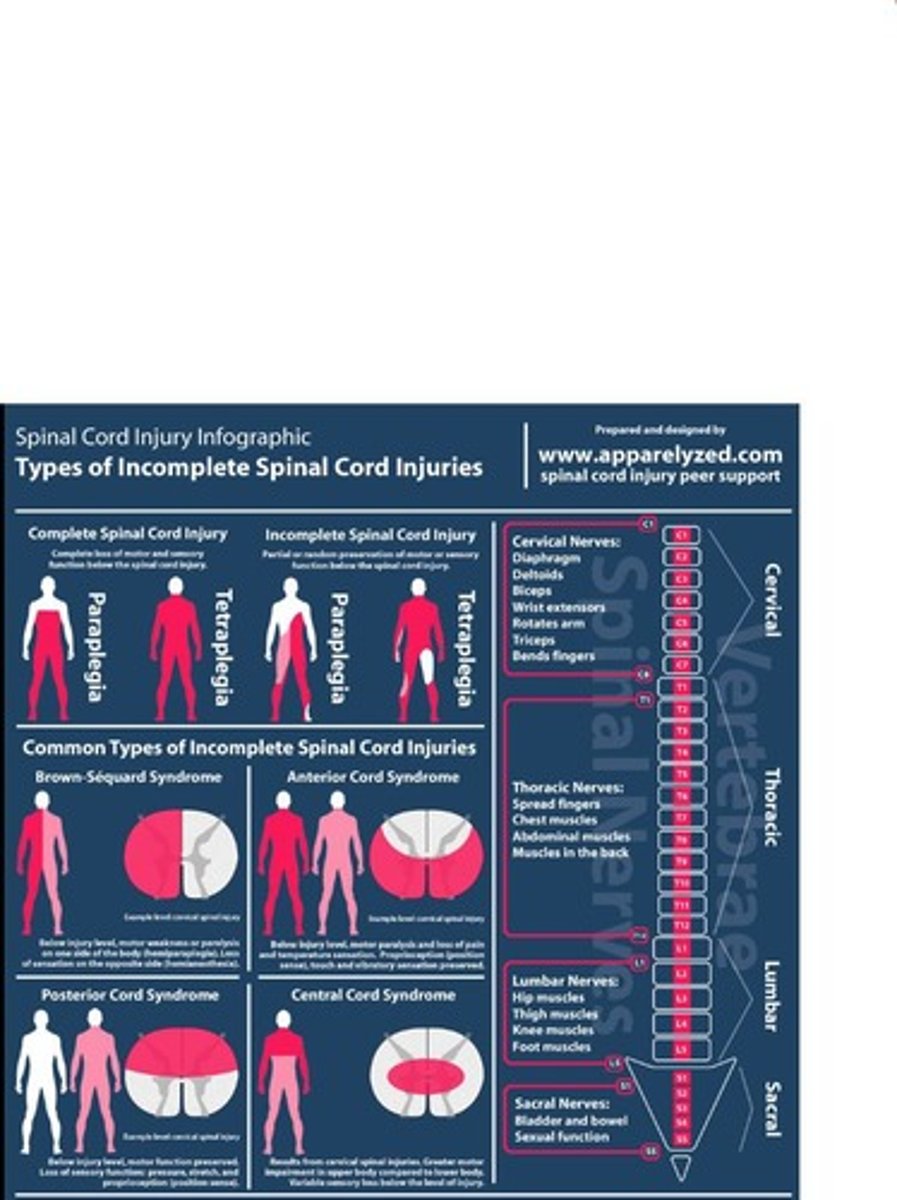 <p>Complete spinal cord injury involves complete transection, severing of the spinal cord.</p>
