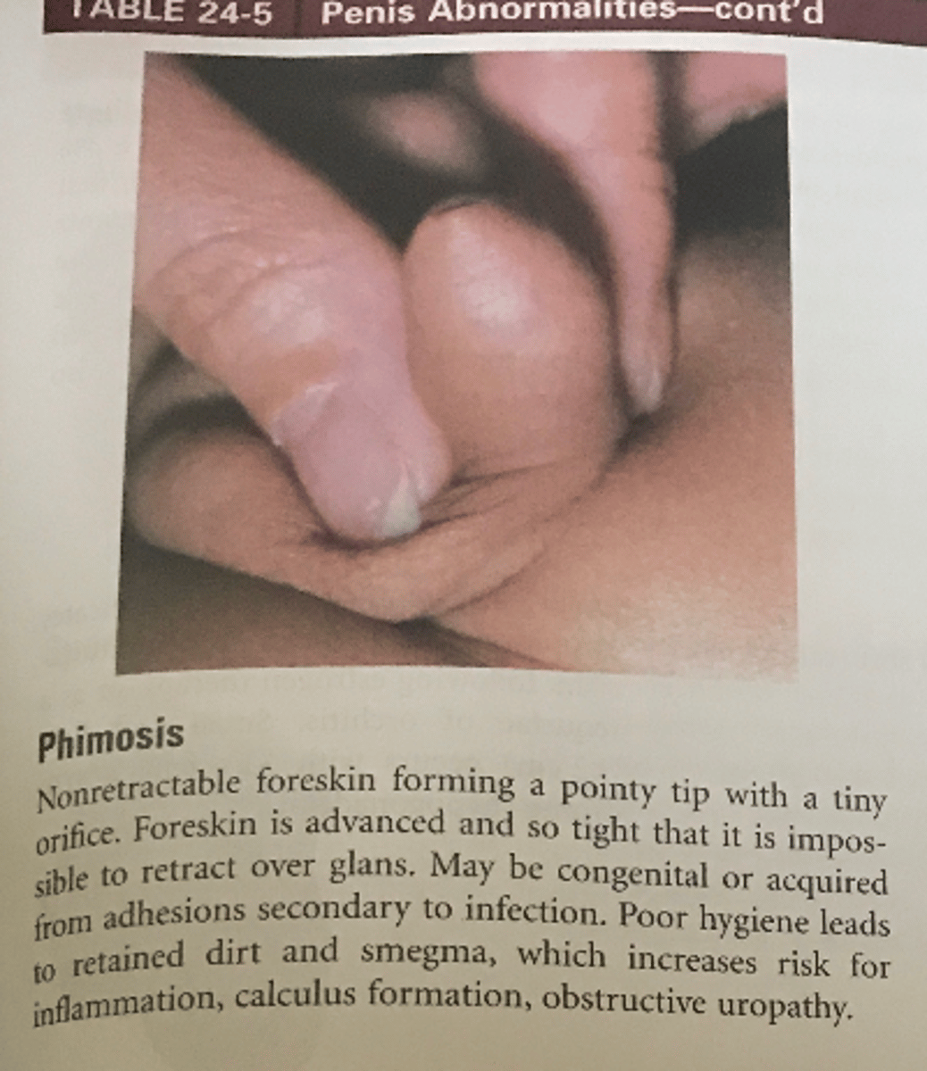 <p>A</p><p>With phimosis, the foreskin is nonretractable, forming a pointy tip of the penis with a tiny orifice at the end of the glans. The foreskin is advanced and so tight that it is impossible to retract over the glans. This condition may be congenital or acquired from adhesions related to infection. (See Table 24-3 for information on urethral stricture. See Table 24-4 for information on epispadias and Peyronie disease.)</p>