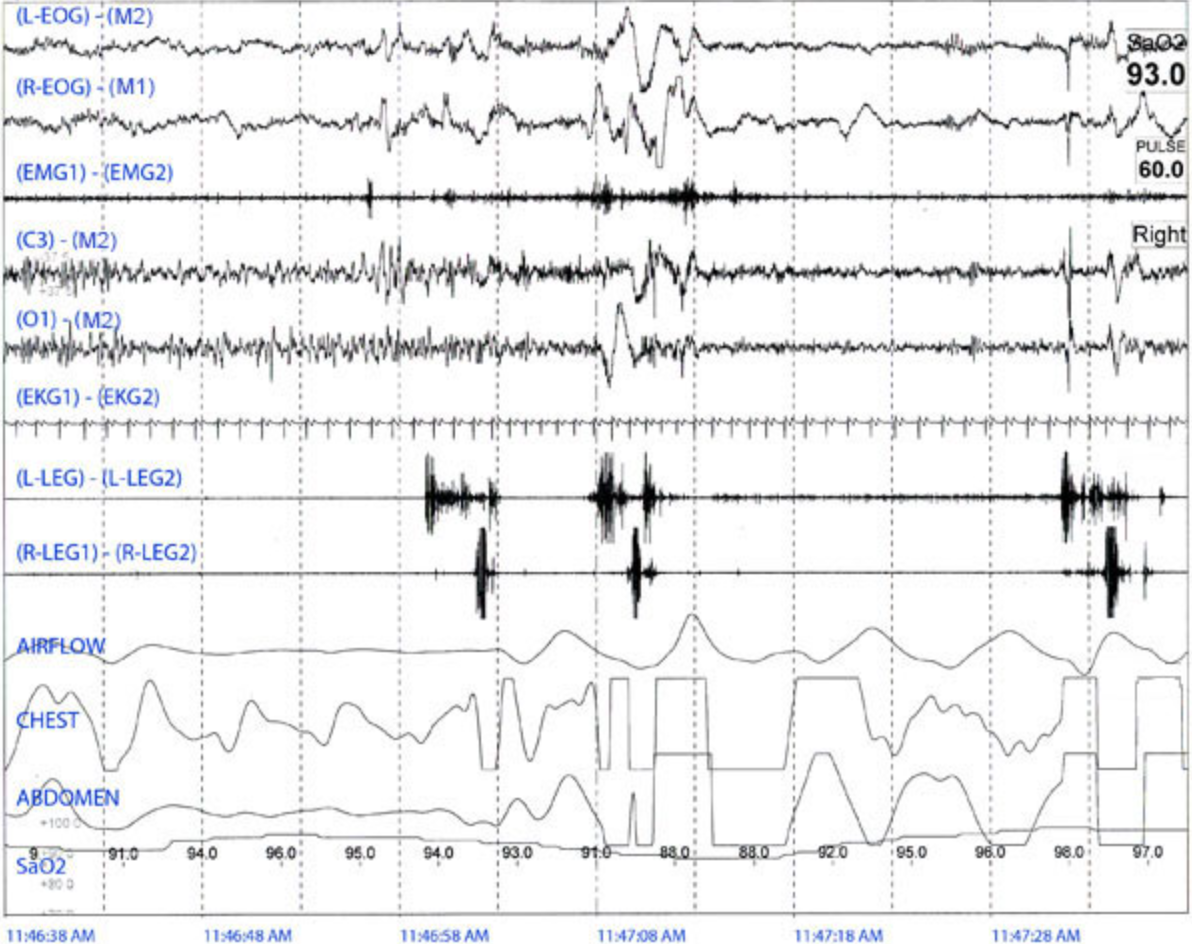 <p>A sleep disorder specialist observes the following 60 second epoch while analyzing the results of a sleep study of an adult. The specialist notes the pattern repeats for the next 30 minutes. Which of the following is the most likely cause for these findings?  </p>