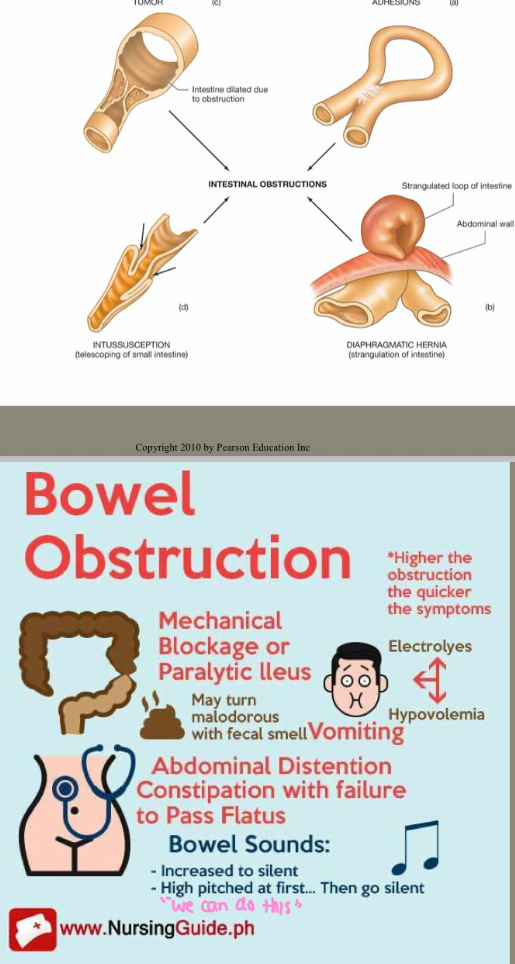 <ul><li><p>Intestinal Musculature cannot propel content along the bowel</p></li><li><p>Causes</p><ul><li><p>Parkinson’s</p></li><li><p>Diabetes Mellitus</p></li><li><p>muscular dystrophy</p></li><li><p>Paralytic ileus</p></li></ul></li></ul><p></p>