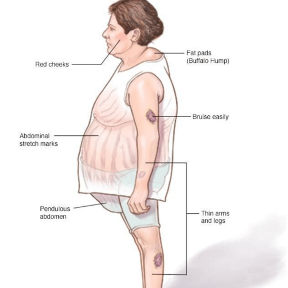 <p>Central obesity (moon facies, buffalo hump), purple abdominal striae, easy bruising, proximal muscle weakness, and hypertension.</p>