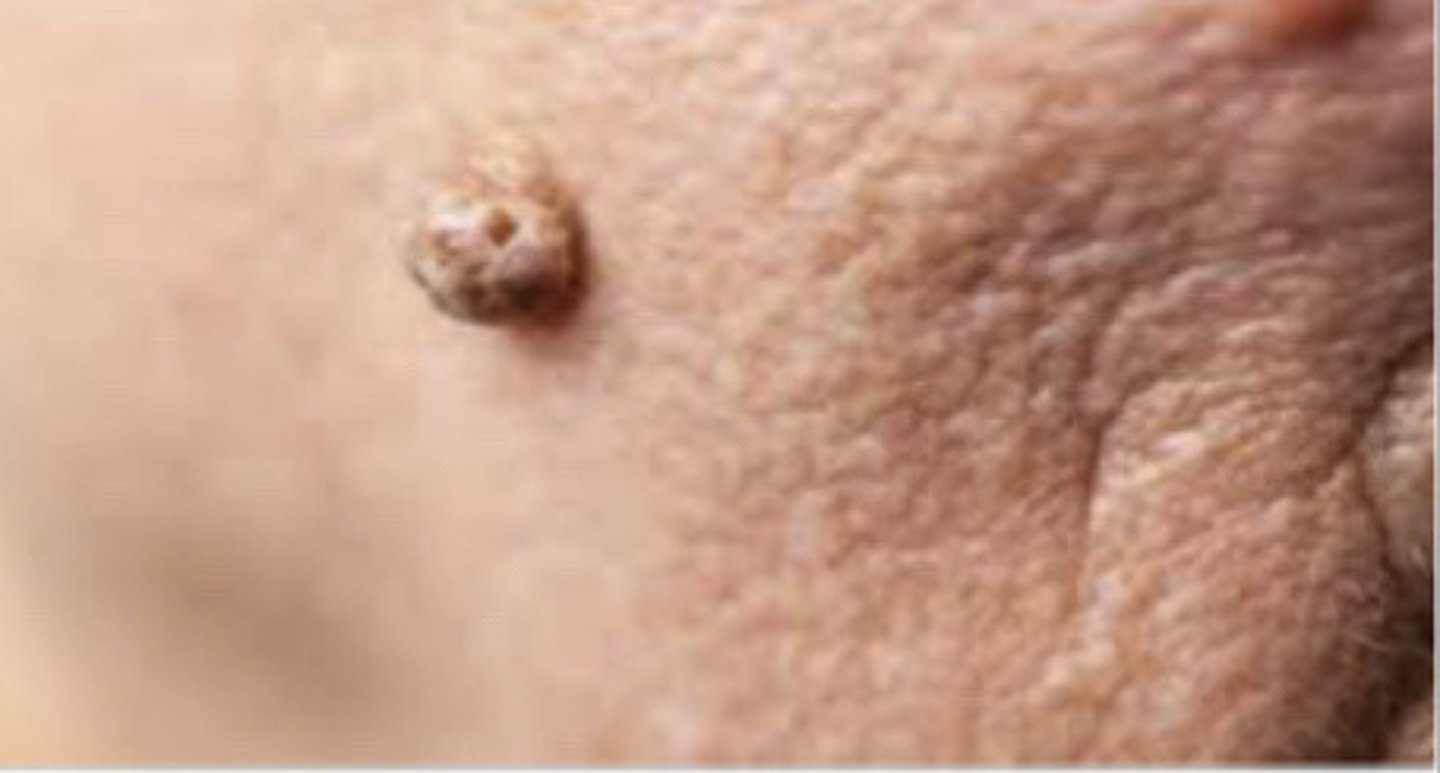 <p>Fibroma</p>
