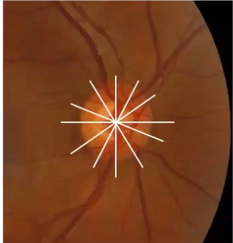 <p>oct scans of the onh (2): BMO scans </p>