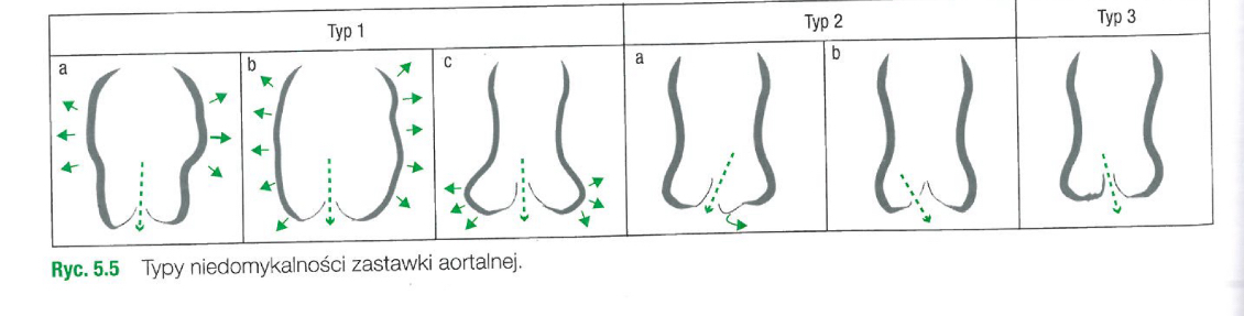 <ul><li><p>typ 1 » przyczyna niedomykalności poszerzenie elementów kompleksu aortalnego </p><ul><li><p>1a - poszerzenie obejmujące STJ i najczęściej dalsze części aorty wstępującej</p></li><li><p>1b - od opuszki aorty i obejmujące dystalne części kompelsku aortalnego</p></li><li><p>1c » poszerzeni ogranzone do pierścienia zastawki aortalnej</p></li></ul></li><li><p>typ 2 » wypadanie płatków (2a) lub perforacja (2b - najczęściej w przebiegu infekcyjnego zapalenia wsierdzia)</p></li><li><p>typ 3 » restrykcja/ograniczenie ruchomości płatków. (organiczne zmiany płątkó∑ pod postacią&nbsp;ich pogrubienia, zwapnienia w wyniku procesów degeneracyjnych i zapalnych)</p></li></ul><p></p>