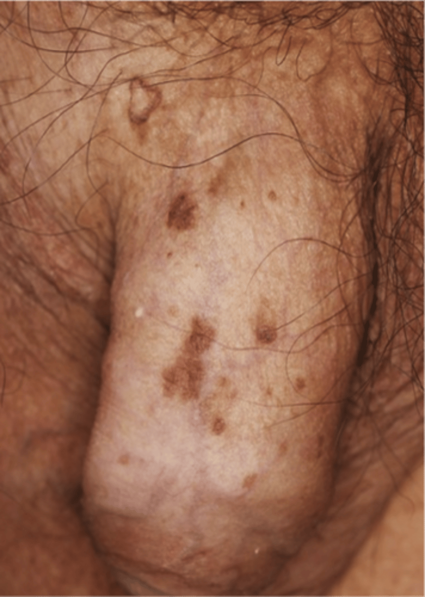 <p>Appears as reddish papules on the shaft </p><p>- Rarely progresses into invasice carcinoma </p>