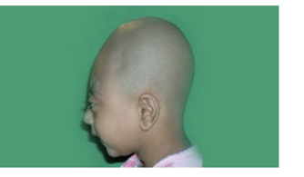 <p>tower skull or high head syndrome </p>
