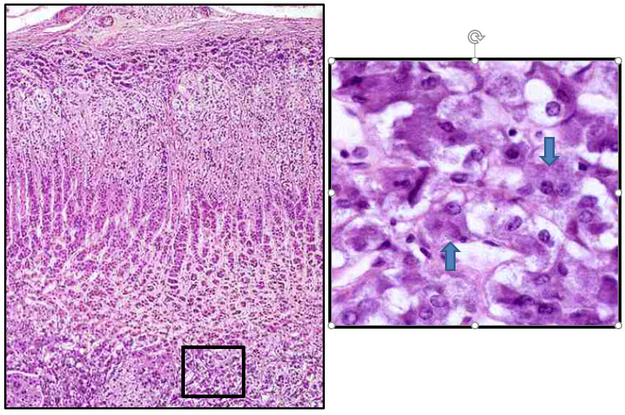 <p>Examine the low and higher power views of this adrenal gland.&nbsp; The boxed in area in the low power view is displayed at higher magnification on the right.&nbsp;</p><p>The cells in the boxed in area in which two are indicated in the higher magnification view secrete which listed as a final product.</p><p>a) aldosterone</p><p>b) glucocorticoids</p><p>c) norepinephrine</p><p>d) epinephrine</p><p>e) renin</p><p>f) intrinsic factor</p>