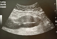 <p>A 75 year old man is seen for f/u of a known AAA. The sonogram reveals a dilated distal Ao that measures 3.9 cm in AP diameter. Mural thrombus is seen in the aneurysm. No increase in size is noted from a sonogram performed 6 months prior. Considering the size of aneurysm and the thrombus that is present, what is the recommended schedule of sonographic surveillance&gt; </p>