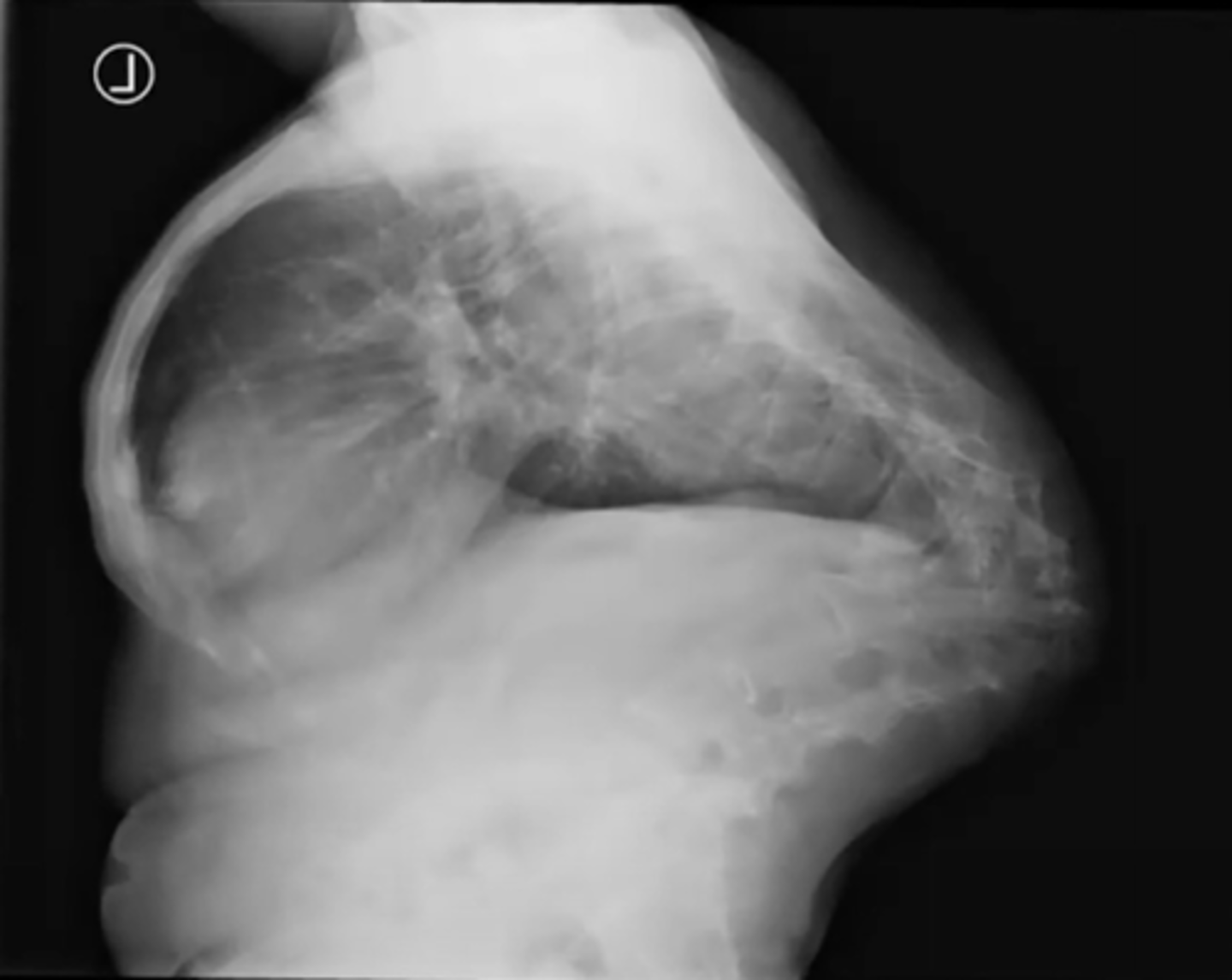 <p>What is this?</p><p>Ex. TB infection at L1</p>