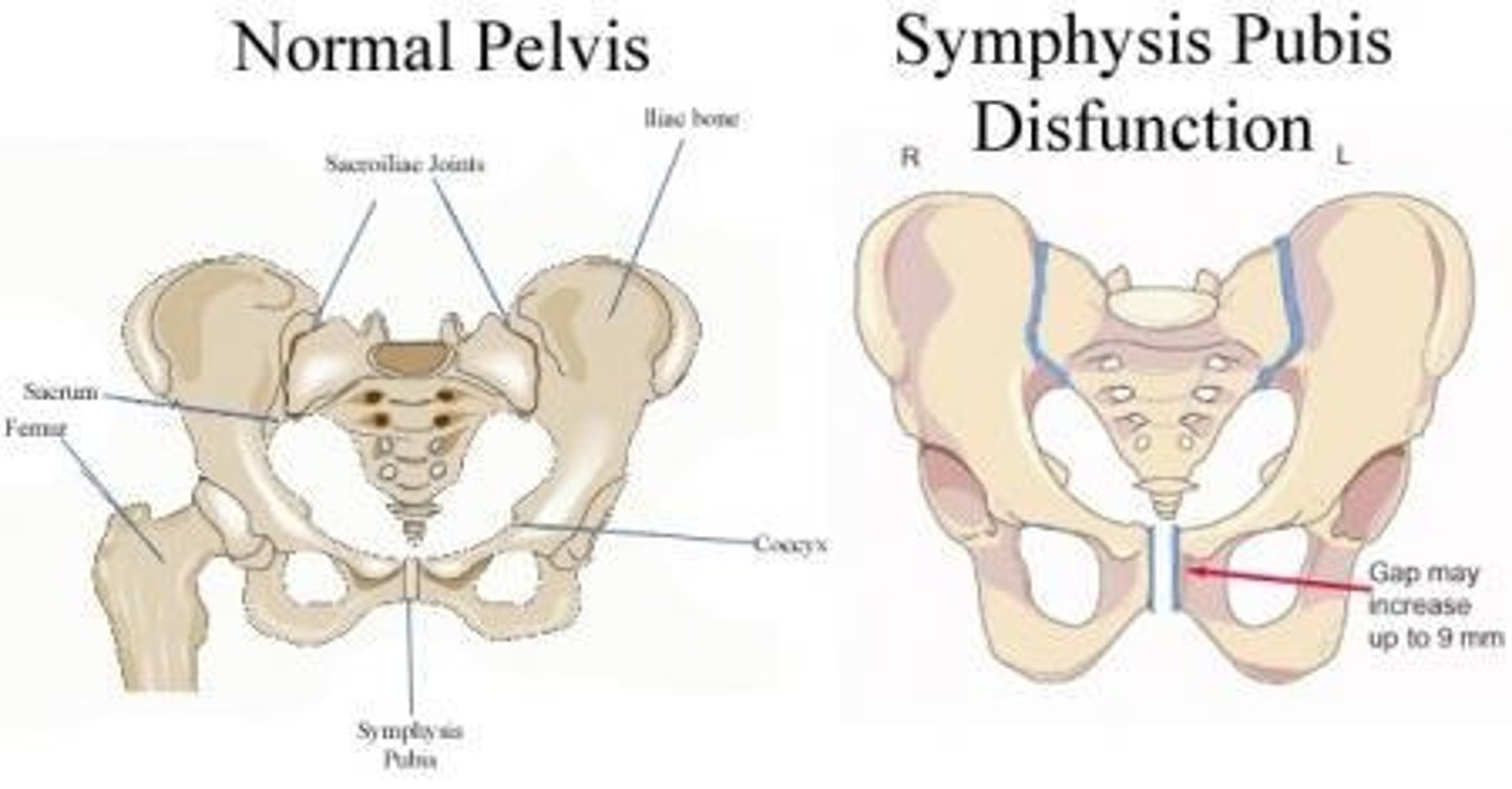 <p>An increase in the gap between the pubic symphysis that can increase as much as 9 mm.</p>