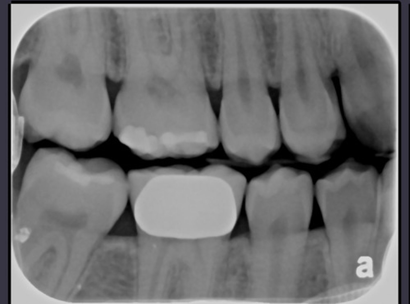 <p>Health or gingivitis</p>