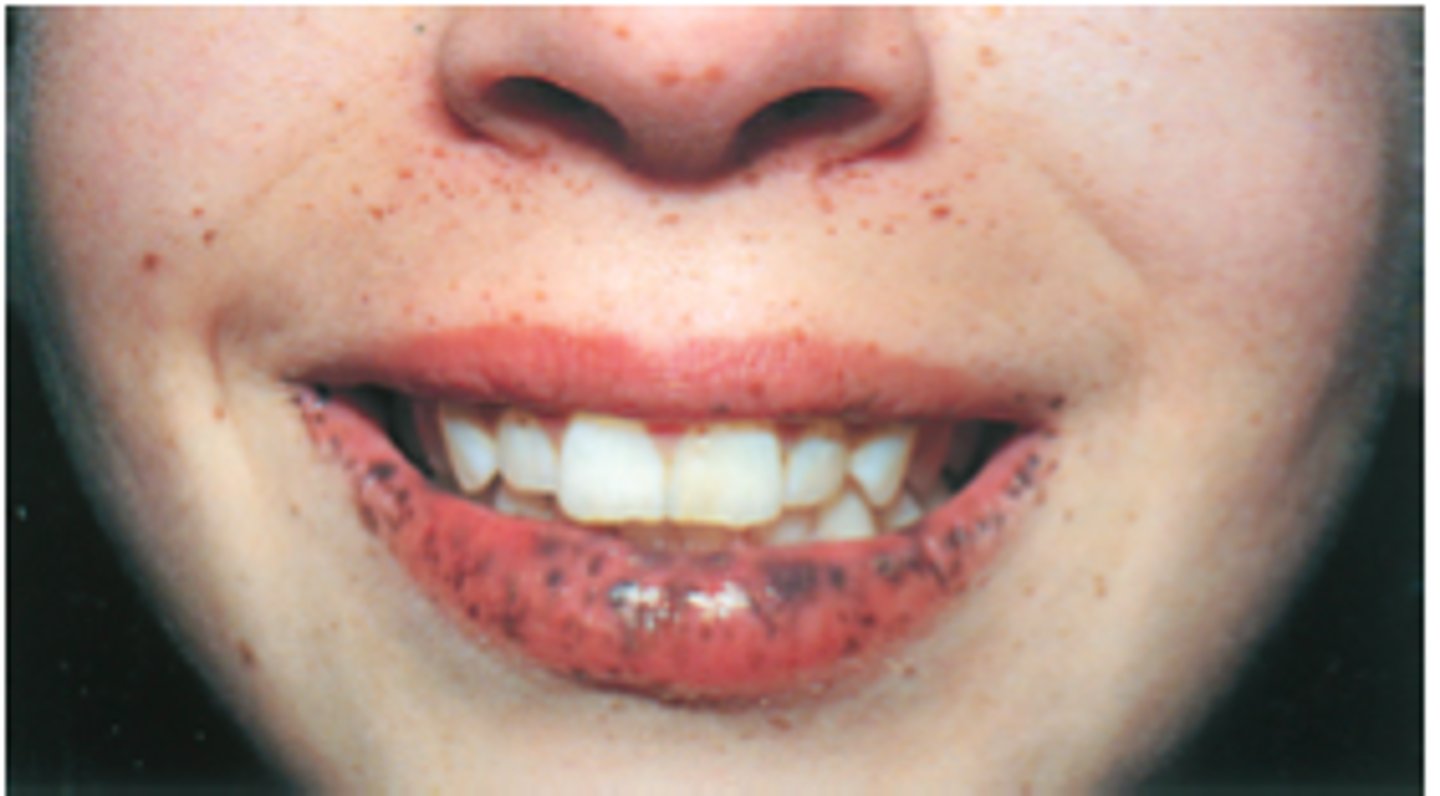 <p>AKA hereditary intestinal polyposis syndrome</p><p>• genetic</p><p>• multiple melanotic macules on buccal mucosa/lips</p><p>• multiple skin macules + benign GI polyps</p><p>• population: Children</p>