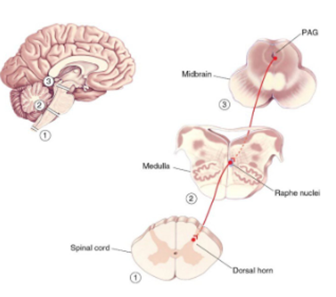 <p>Electrical stimulation of periaqueductal gray matter (PAG) results in analgesia (being pain-free while conscious)<br><br>PAG receives input from parts of brain involved w/ emotional state, which descend to spinal cord.</p>
