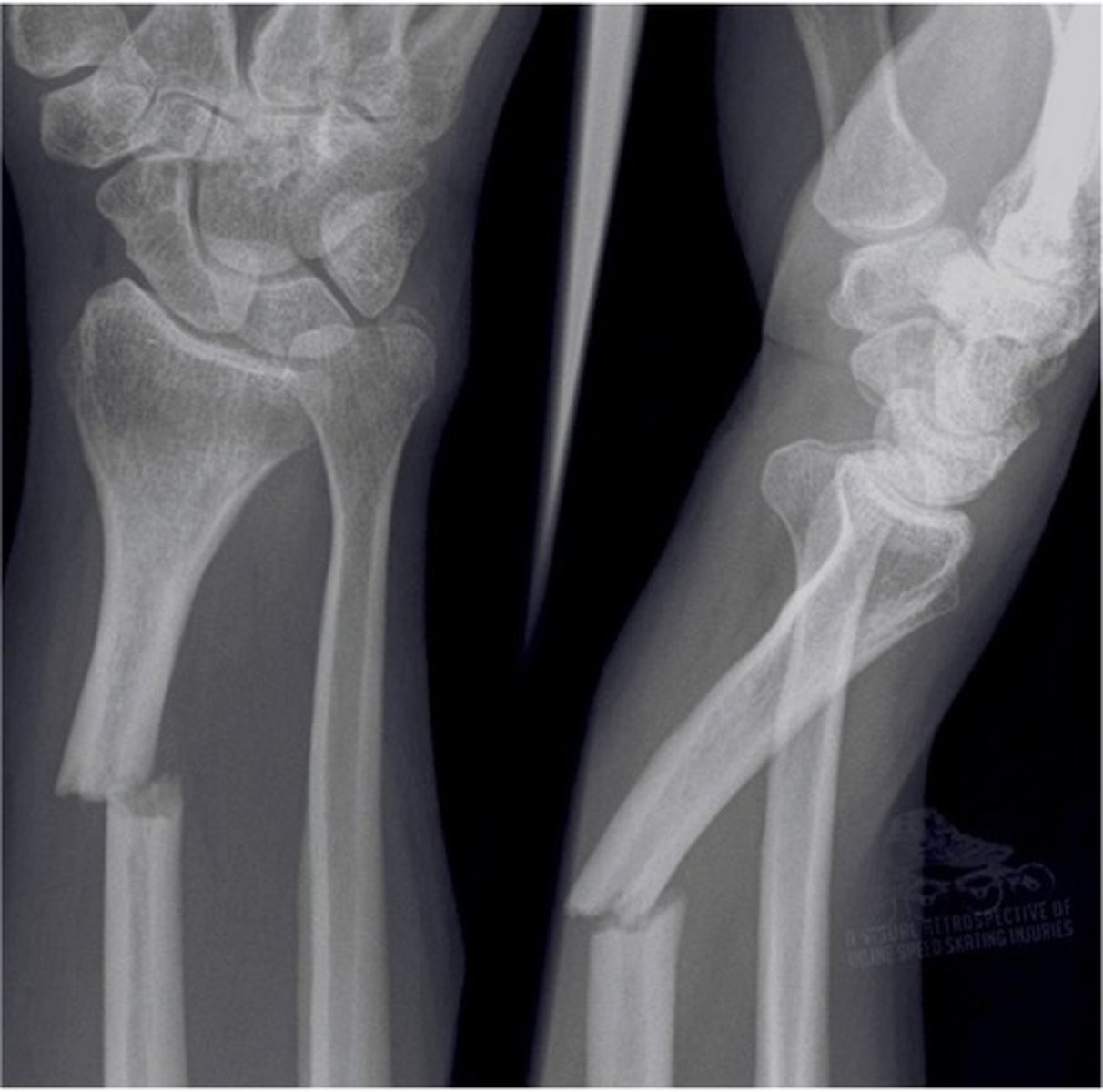 <p>fracture through the bone that is broken into 2 pieces (transverse, oblique, spiral)</p>