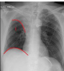 <ul><li><p><strong>Elevation of hemidiaphragm</strong></p></li><li><p>decrease in rib spacing</p></li><li><p>displacement of mediastinum, hilum, fissure - <strong>volume loss</strong></p></li></ul><p></p>