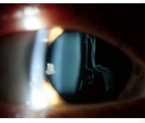 <ol><li><p>visualize movement of the anterior vitreous </p></li><li><p><strong><u>dilated pupil </u></strong></p></li><li><p><u>parallelpiped depper than posterior lens capsule</u></p></li><li><p><strong><u>instruct pt to look up and then straight ahead</u></strong></p></li><li><p>observe vitreous fibers floating down </p></li></ol><p></p>