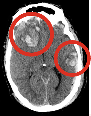 <p>Result of an external force; is of sufficient magnitude to interfere with daily life and warrants treatment.</p><ul><li><p><strong>Leading causes</strong>:</p><ul><li><p>Falls (48%)</p></li><li><p>MVCs (14%)</p></li><li><p>Being struck by objects (15%)</p></li><li><p>Assaults (10%)</p></li></ul></li><li><p><strong>Primary vs. Secondary injury:</strong></p><ul><li><p><strong><em>Primary injury</em></strong>: consequence of direct contact to head/brain during instant of initial injury → extracranial focal injuries &amp; focal injuries from sudden movement of the brain within cranial vault (subdural hematomas, concussions, DAI)</p></li><li><p><strong><em>Secondary injury</em></strong>: evolves over time after initial injury; d/t inadequate delivery of glucose &amp; oxygen to cells</p><ul><li><p>Intracranial pathologic processes -- intracranial hemorrhage, cerebral edema, intracranial hypertension, hyperemia, seizures, vasospasm</p><ul><li><p>Other things that could affect this: hypotension, hyperthermia, hypoxia, hypercarbia, infection, electrolyte imbalances, anemia → further complicate an already complex injured brain</p></li></ul></li></ul></li></ul></li><li><p><strong>Monroe-Kellie hypothesis:</strong></p><ul><li><p>Volume in blood, brain or CSF ↑ → other 2 have to compensate to prevent ICP</p></li><li><p>Pressure → displaces brain against or through skull → restriction of blood flow to brain → decreased oxygen delivery &amp; waste removal → anoxia; inability to metabolize properly → ischemia, infarction, irreversible brain damage → brain death</p></li></ul></li></ul><p></p>