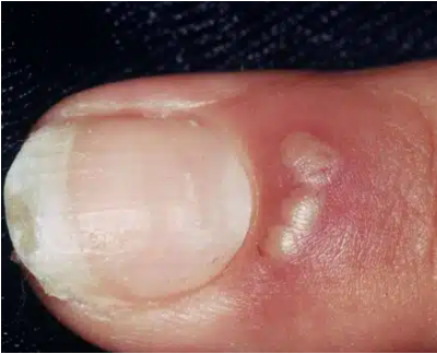 <p>herpes infx of finger pad</p>