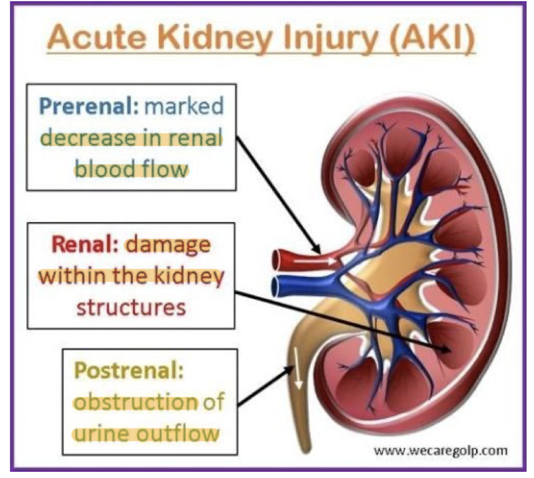 <ul><li><p>Typically caused by tubular necrosis</p><ul><li><p>Can also be caused by toxins, Contrast media, heavy metals, myoglobin from crush injuries</p></li></ul></li><li><p>Low urine output</p></li><li><p>Low urine osmolality</p></li><li><p>High urine sodium</p></li></ul><p></p>