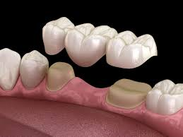 <p>A fixed restoration that replaces one or more missing teeth, anchored to nearby teeth or implants.</p>