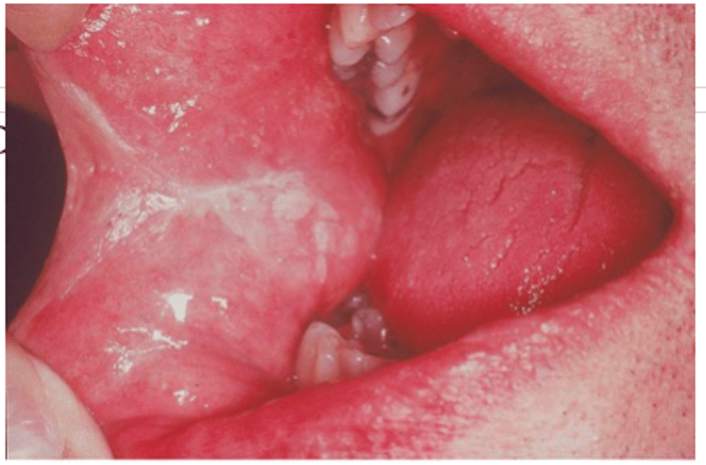 <p>usually due to cheek biting, and is thicker than linea alba</p>