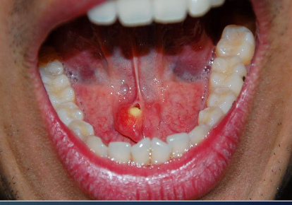 <p>yellowish calcified structures that may appear on radiograph, causes swelling before or during eating </p>