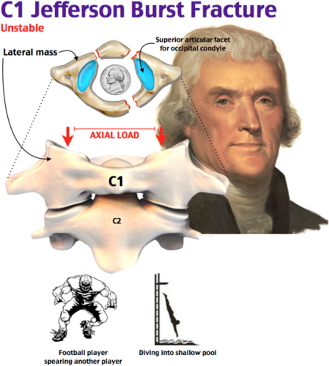 <p>Jefferson fracture </p><p>1. Anterior &amp; Posterior rings of C1 (burst fx)</p><p>2. Axial Loading (i.e. patient falls on head, direct blow to head)</p><p>3. C2 fx </p><p>4. Unstable (even though most do not cause spinal cord injury) </p>