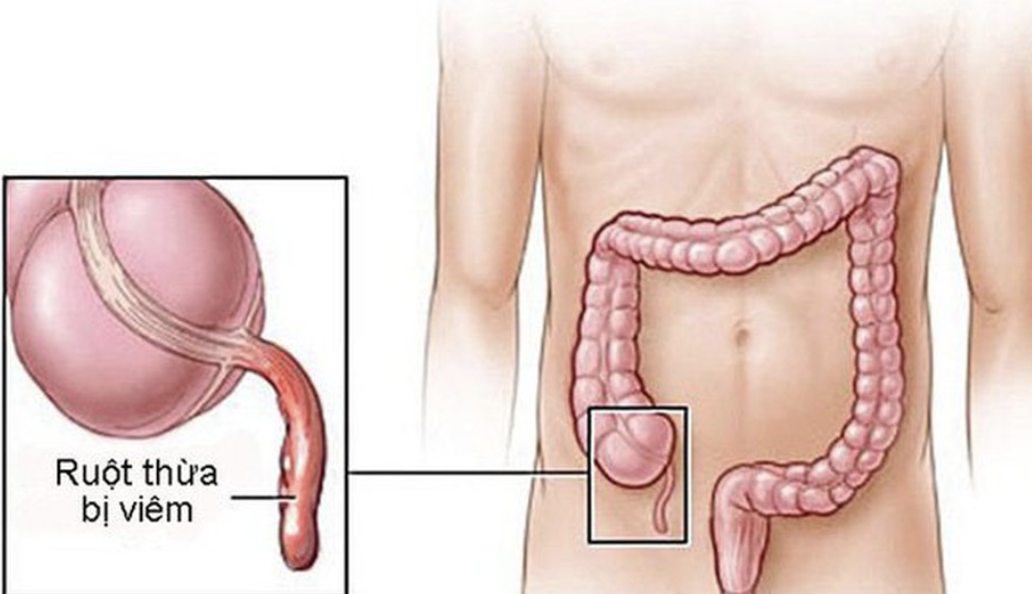 <p>Appendicitis (appendic-)</p>