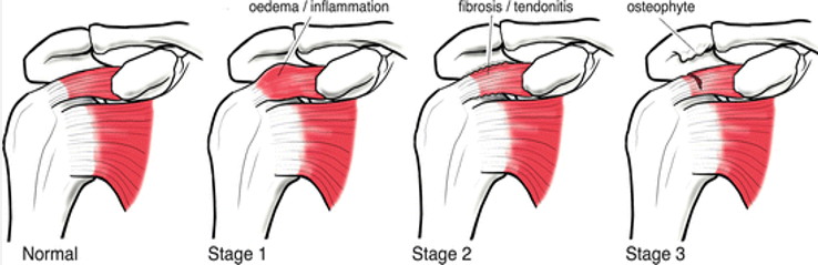 <p>tendon overload inflammation can cause SAIS, what is the presentation of Neers Stage 1?</p>