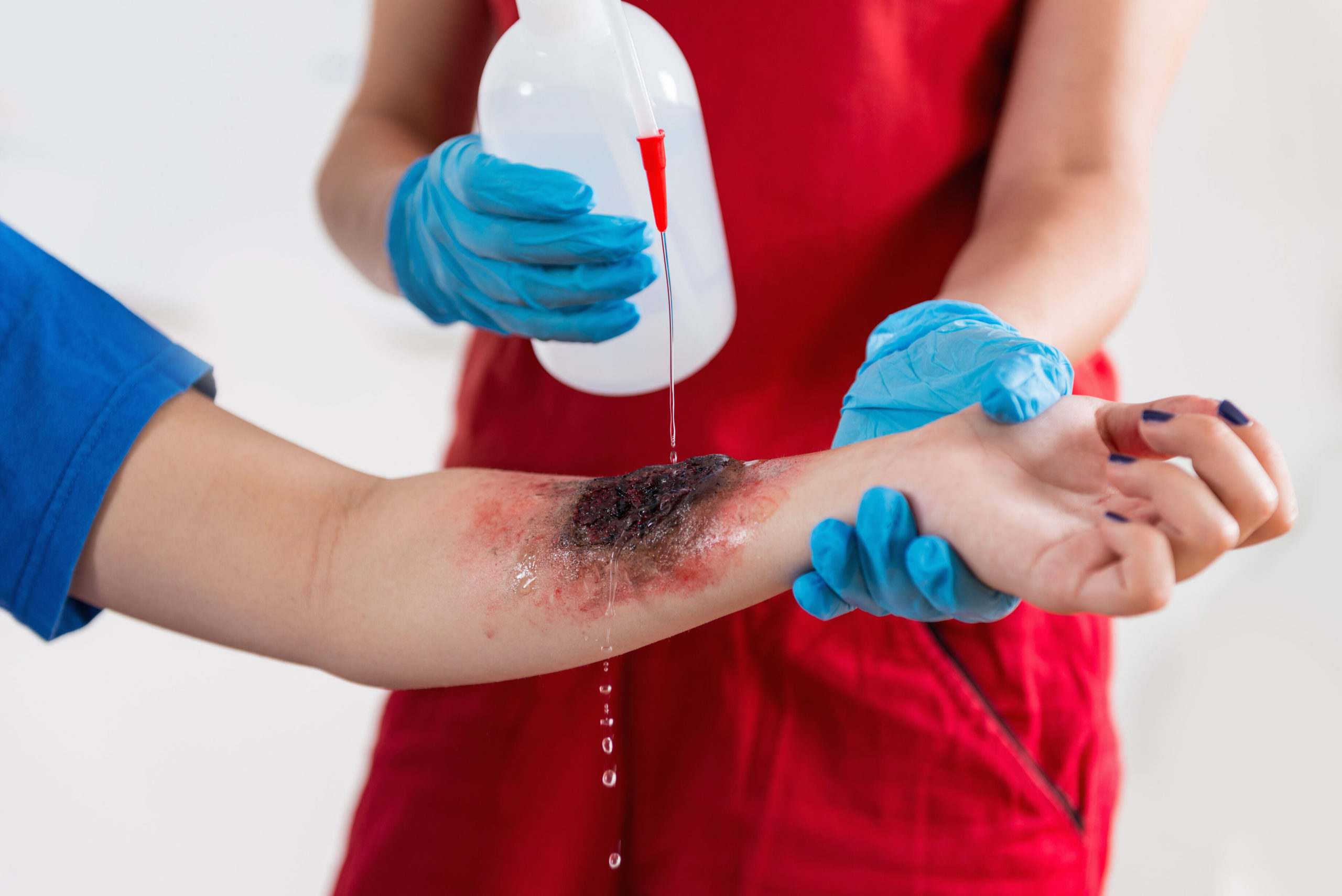 <p>4th degree burn</p>