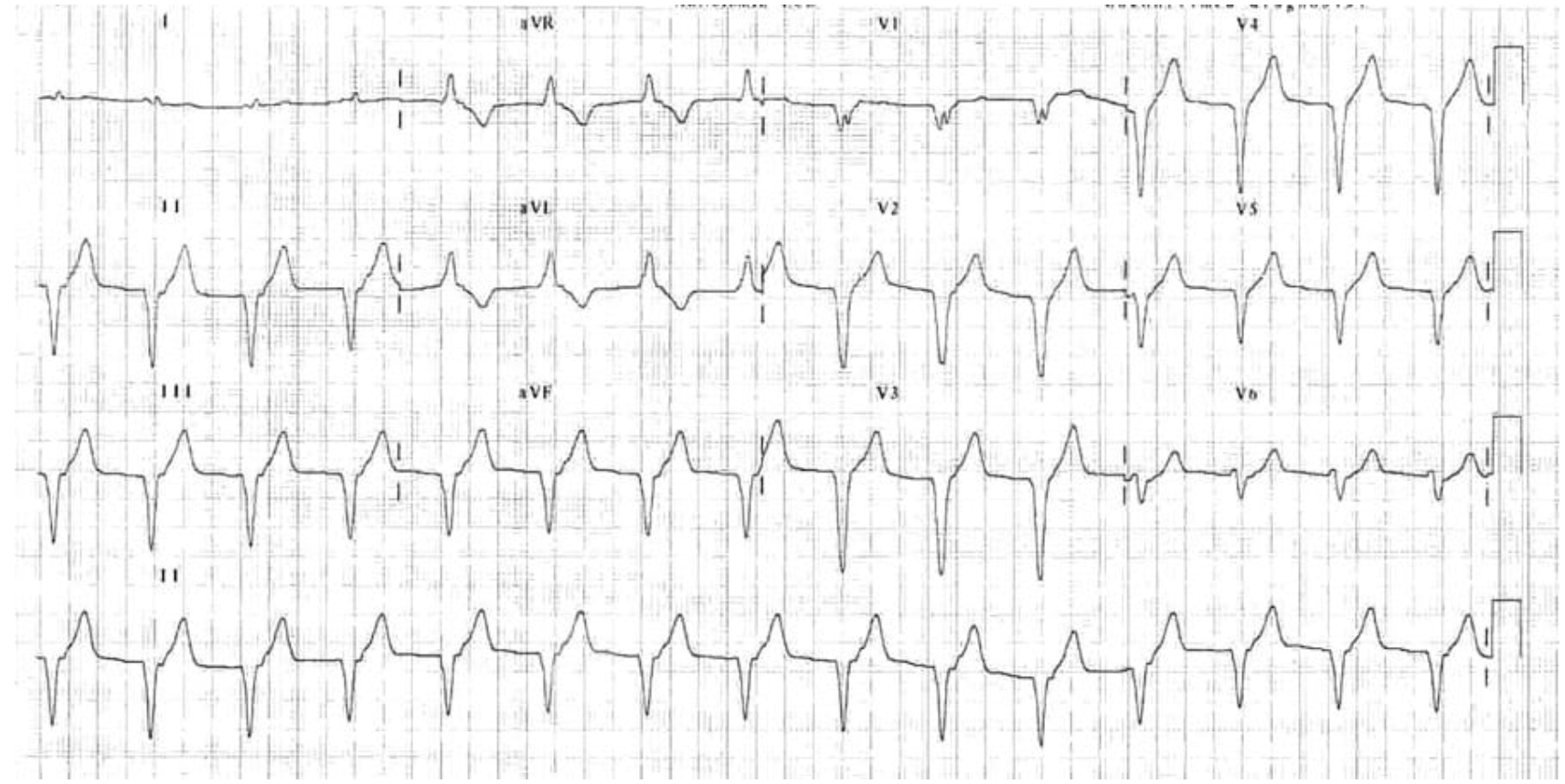 <p>How do you treat an accelerated idioventricular rhythm?</p>